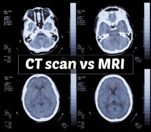 Ct scan vs MRI