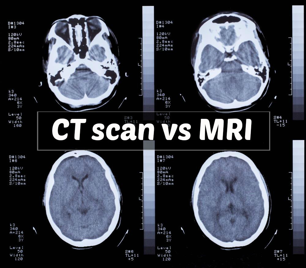 Ct scan vs MRI